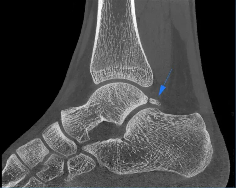 Голеностопный сустав поверхности. Краевой перелом таранной кости. Перелом таранной кости стопы рентген. Перелом заднего отростка таранной кости. Краевой перелом таранной кости рентген.