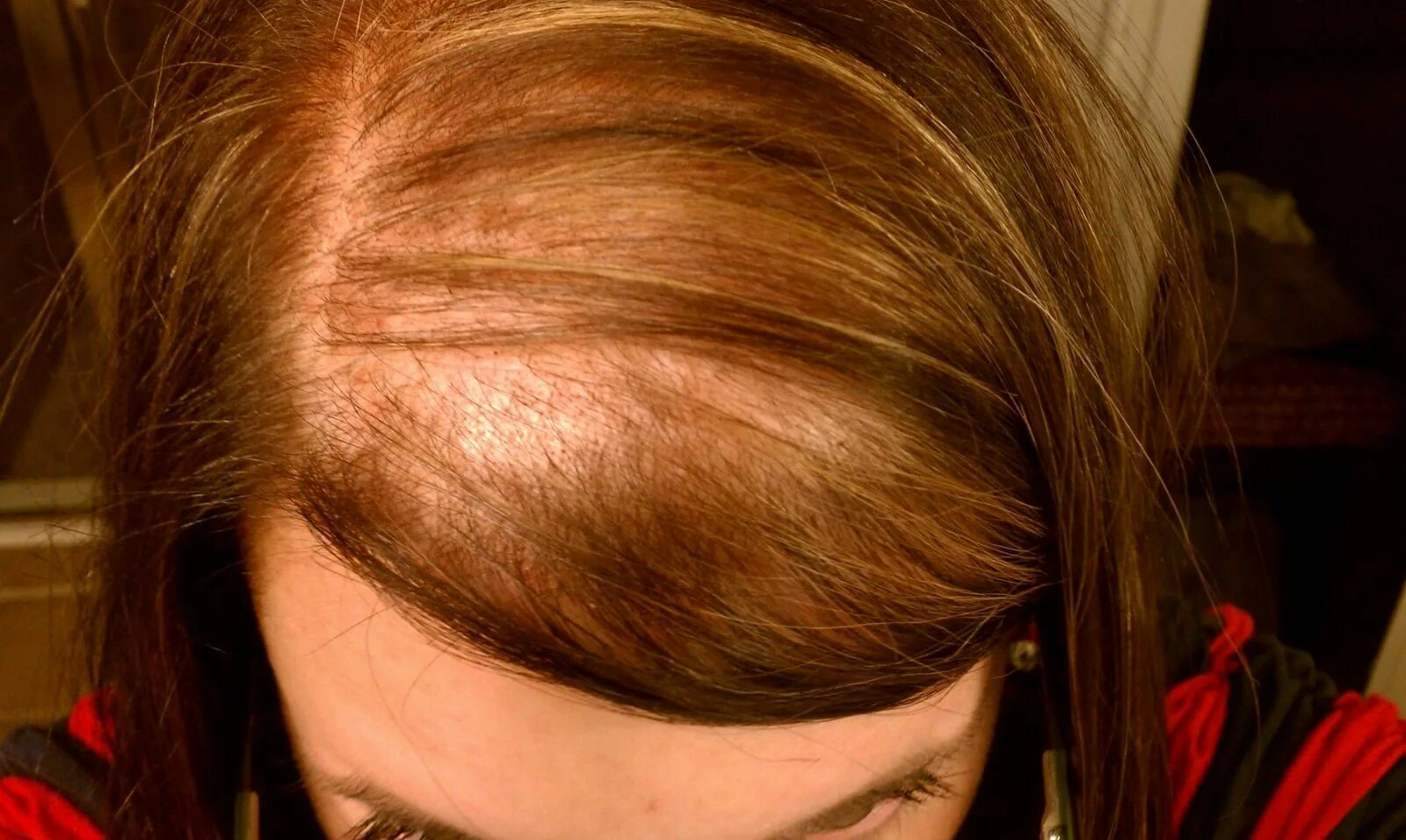 Выпадают волосы что делать причины лечение. Андрогенная алопеция алопеция. Редкие волосы. Редкие волосы у женщин. Очень редкие волосы на голове.