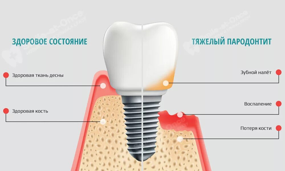 Воспаление десны вокруг имплантата. Отторжение имплантата зуба. Симптомы отторжения имплантата. Неприятные поверхности