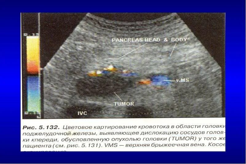 4 стадия поджелудочной железы сколько живут. Опухоль крючковидного отростка поджелудочной железы УЗИ. Диагностика образования головки поджелудочной железы. Объемное образование головки поджелудочной железы. Опухоль поджелудочной железы на УЗИ.