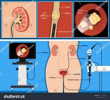 Лазерная операция почки камень