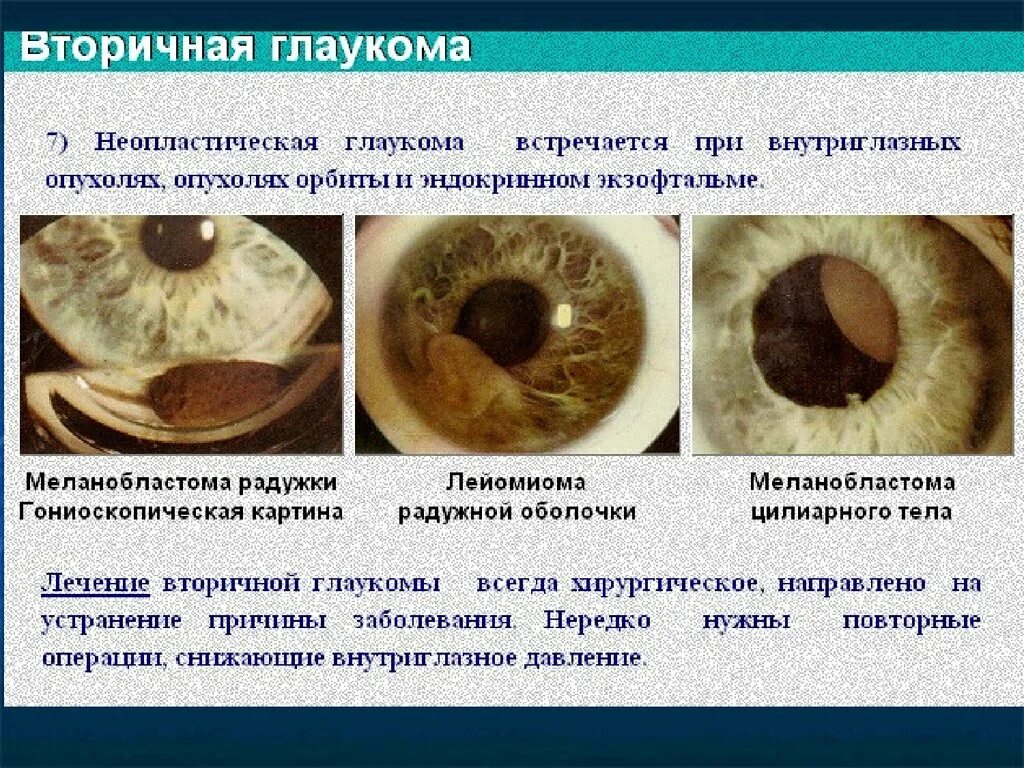 Глаукома глаза причины. Вторичная факолитическая глаукома. Неопластическая глаукома. Причины послевоспалительной вторичной глаукомы.