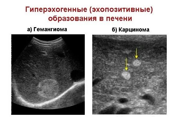 Округлые образования печени. Гиперэхогенные образования в печени на УЗИ. Гиперэхогенное образование в печени на УЗИ что это такое.