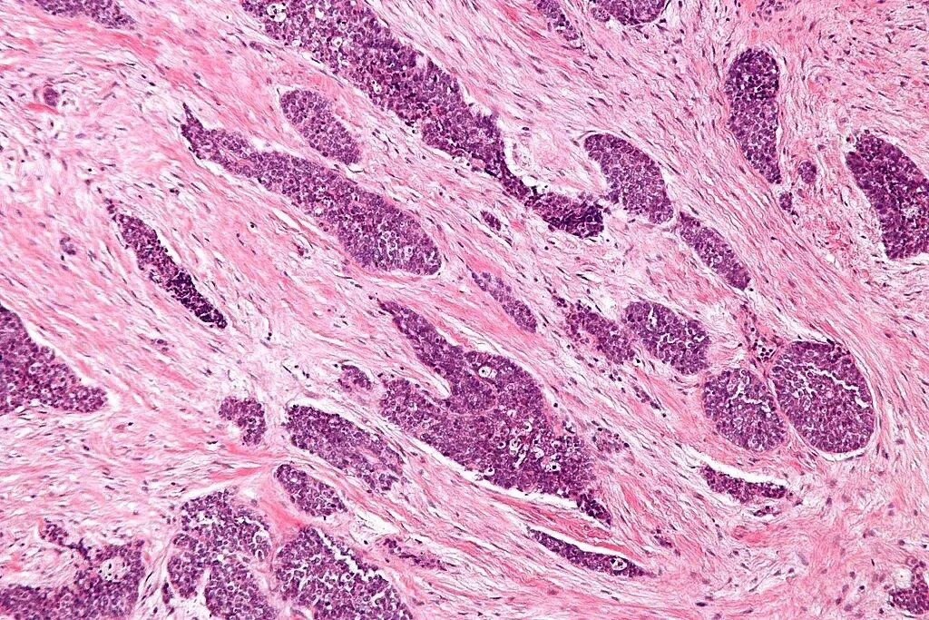 Плеоморфная аденома гистология. Squamous Cell carcinoma гистология. Миосаркома гистология. Десмопластическая Строма. Злокачественная опухоль из соединительной