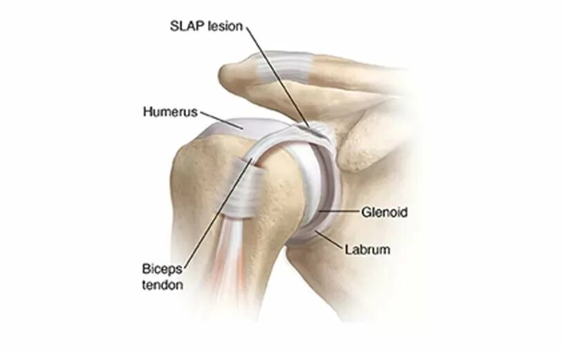 Slap синдром плечевого сустава. Слап повреждение плечевого сустава. Slap операция плечевого сустава. Slap синдром плечевого сустава операция.