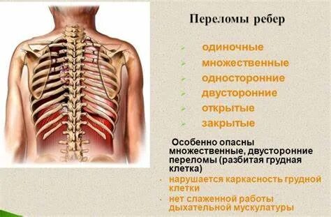 Перелом ребер карта