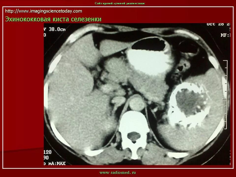 Киста селезенки лечение. Эхинококковая киста селезенки кт. Эхинококковая киста селезенки мрт. Эхинококк селезенки УЗИ.