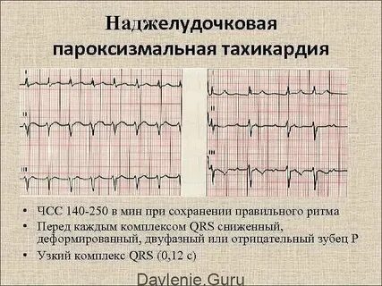 Сколько живут с тахикардией