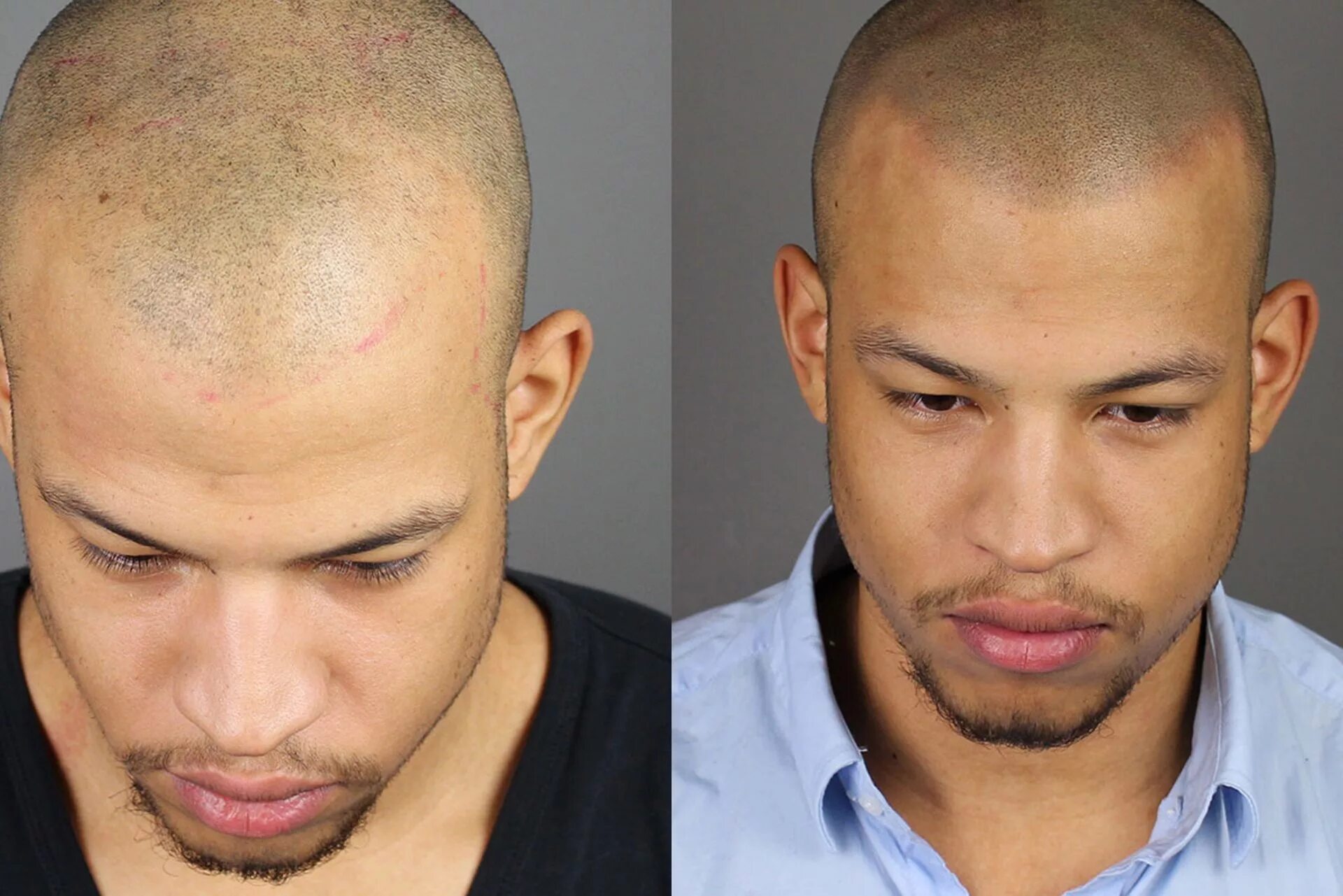 микропигментация скальпа. андрей афанасьев трихопигментация. Hair transplant. татуаж головы мужчины. татуаж волос для лысеющих мужчин.