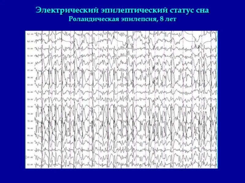 Диффузные эпилептиформные. Роландические спайки на ЭЭГ. Роландическая эпилепсия ЭЭГ. Эпистатус на ЭЭГ. Доброкачественная роландическая эпилепсия.