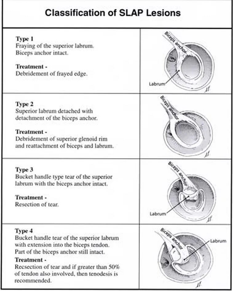 Классификация slap повреждения. Slap повреждение плечевого сустава классификация. Slap синдром плечевого сустава мрт.