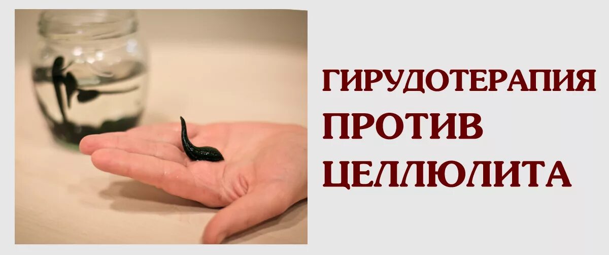 Выразить гирудотерапия эффект. Гирудотерапия реклама. гирудотерапия картинки. гирудотерапия это в медицине.