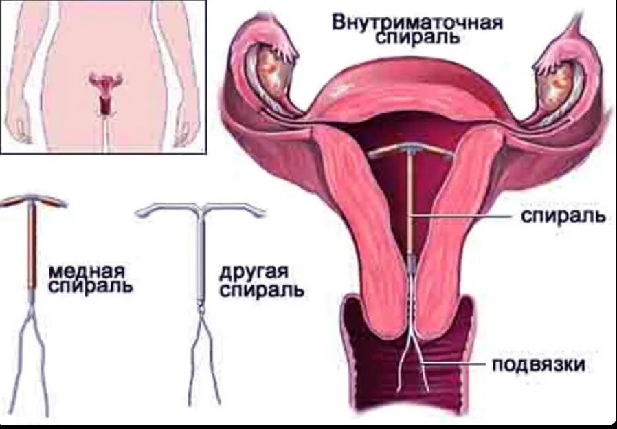 Введение вмс. Внутриматочная контрацепция (ВМК). Внематочная беременность со спиралью. Внутриматочная спираль в матке.