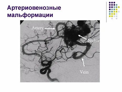 Венозная мальформация мкб