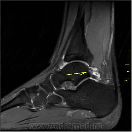 Импиджмент синдром голеностопного сустава мрт. Задний импинджмент синдром голеностопного сустава. Импинджмент синдром голеностопного сустава рентген. Os Trigonum таранной кости мрт.