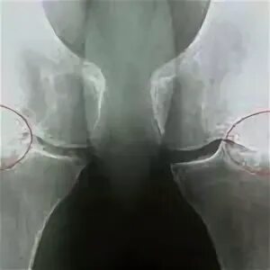 Гонартроз нфс. Гонартроз коленного сустава. ортез на коленный сустав при гонартрозе 3 степени.
