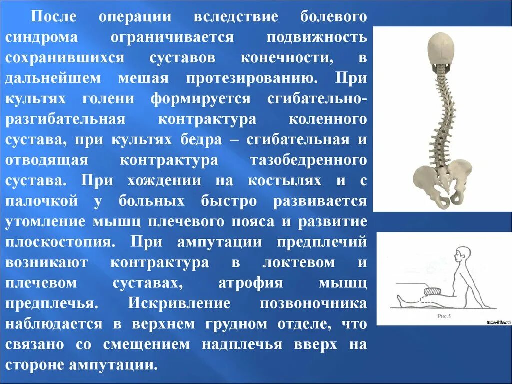 Лечение после ампутации. Реабилитация при ампутации ноги. Реабилитация после потери конечности. Лечебная гимнастика при ампутации ноги. Реабилитация при ампутации стопы.