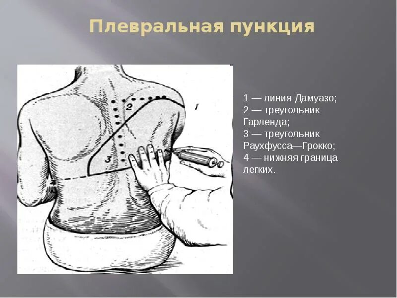Техника выполнения плевральной пункции. Гидроторакс пункция плевральной полости. Линия Дамуазо треугольник Гарленда. Пункция плевральной полости алгоритм.
