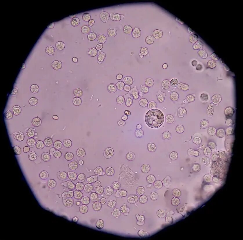 Macrophage In Urine Sediment Stock Photo Download Image Now iStock