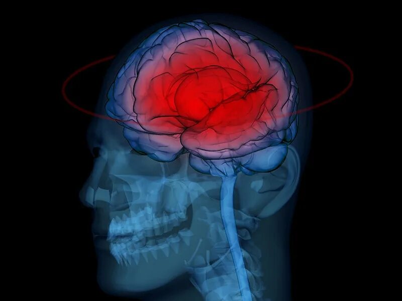 Traumatic brain. Голова ломка Brainwave. Rdr Brain injury.