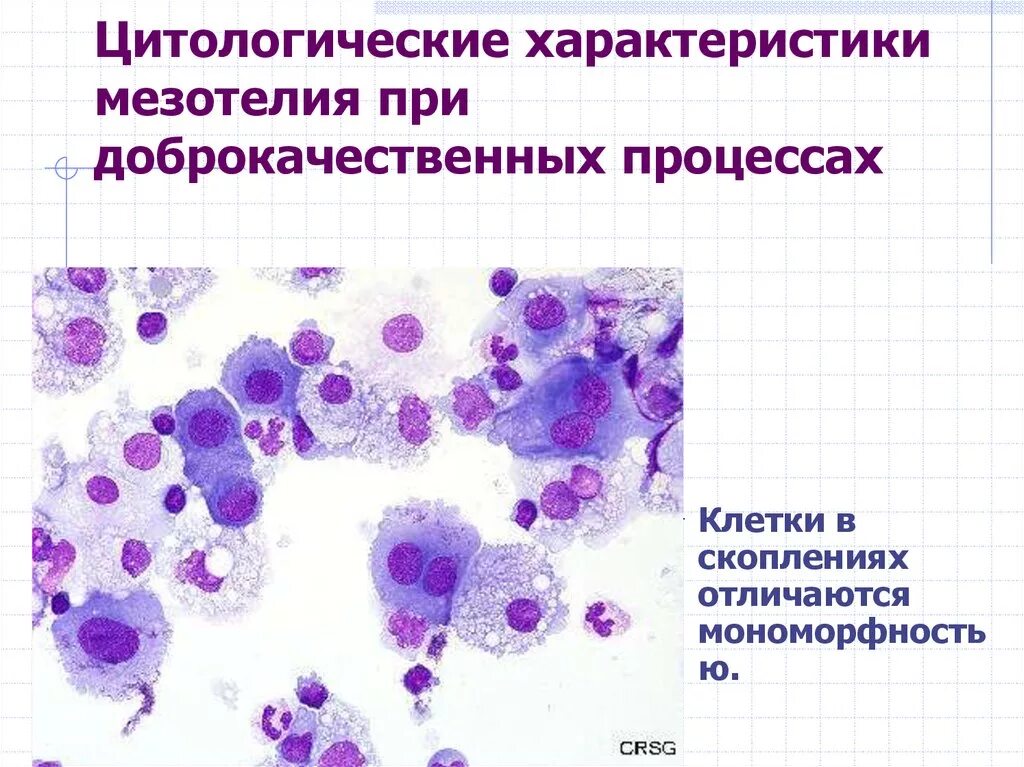 Реактивные изменения в цитологическом. Цитология выпотных жидкостей атлас. Реактивный мезотелий цитология. Шабалова цитологический атлас выпотные жидкости. Микроскопия выпотных жидкостей.