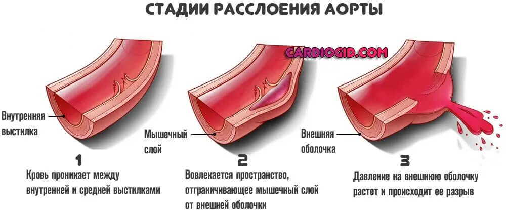 Симптомы при расслаивающейся аневризме аорты. Расслоение аневризмы аорты клиника. Аневризма аорты патогенез. Проксимальное расслоение аорты.