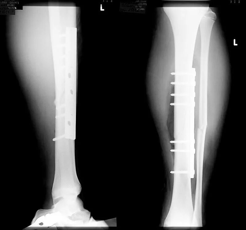 Перелом большеберцовой кости остеосинтез. Остеосинтез голени рентген. Экстрамедуллярный остеосинтез голени. Остеосинтез малой берцовой Кост.