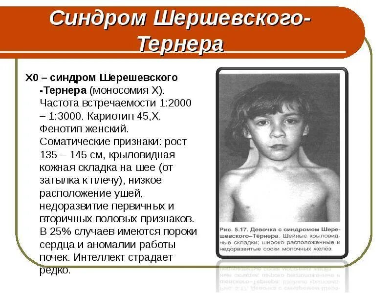 Синдром шерешевского тернера кратко. Синдром шерешевского-тернера симптомы проявлениях. синдром шерешевского-тернера (моносомия х-хромосомы). клинические проявления шерешевского-тернера основные. синдром шерешевского тернера кариотип 45х.