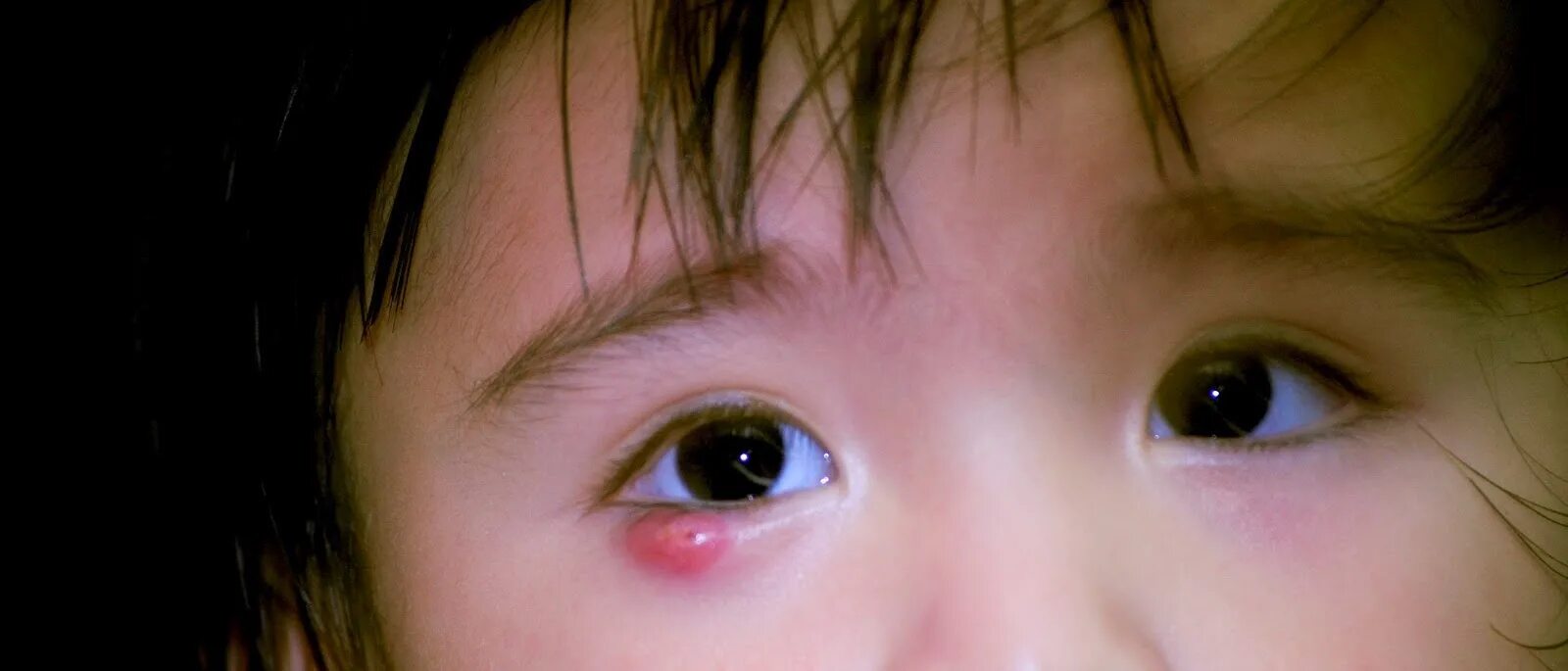 Проблемы с глазами у детей. Катаральный конъюнктивит. Тёмные круги под глазами у ребёнка. Бактериальный гнойный конъюнктивит. Проблемы с глазами у детей.