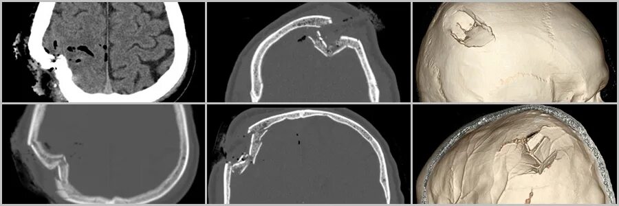 Многооскольчатый перелом черепа. Перелом костей черепа компьютерная томография. Перелом костей свода черепа рентген. Перелом костей свода черепа на кт. Оскольчатый перелом черепа кт.