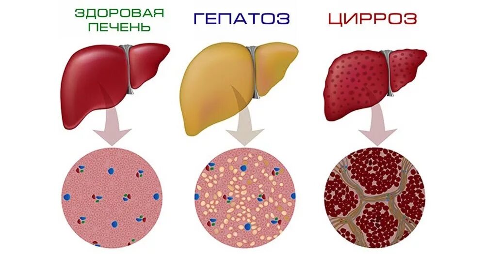 Жирового гепатоза печени. Неалкогольный жировой гепатоз. Жировой гепатит печени. Жировая дистрофия печени.