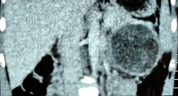 Псевдопапиллярная опухоль поджелудочной железы. Псевдопапиллярная опухоль поджелудочной железы. Псевдопапиллярная опухоль поджелудочной железы. Нейроэндокринная опухоль гистология. Объемное образование поджелудочной железы кт.