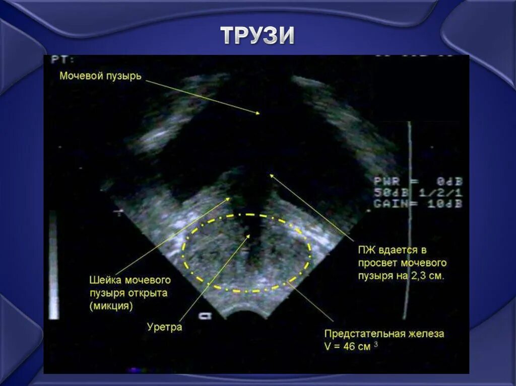 Трансректальное УЗИ простаты. Трансректальное УЗИ предстательной железы (+УЗИ мочевого пузыря. Ультразвуковое исследование предстательной железы трансректально. УЗИ трузи предстательной железы. Операция шейки мочевого пузыря