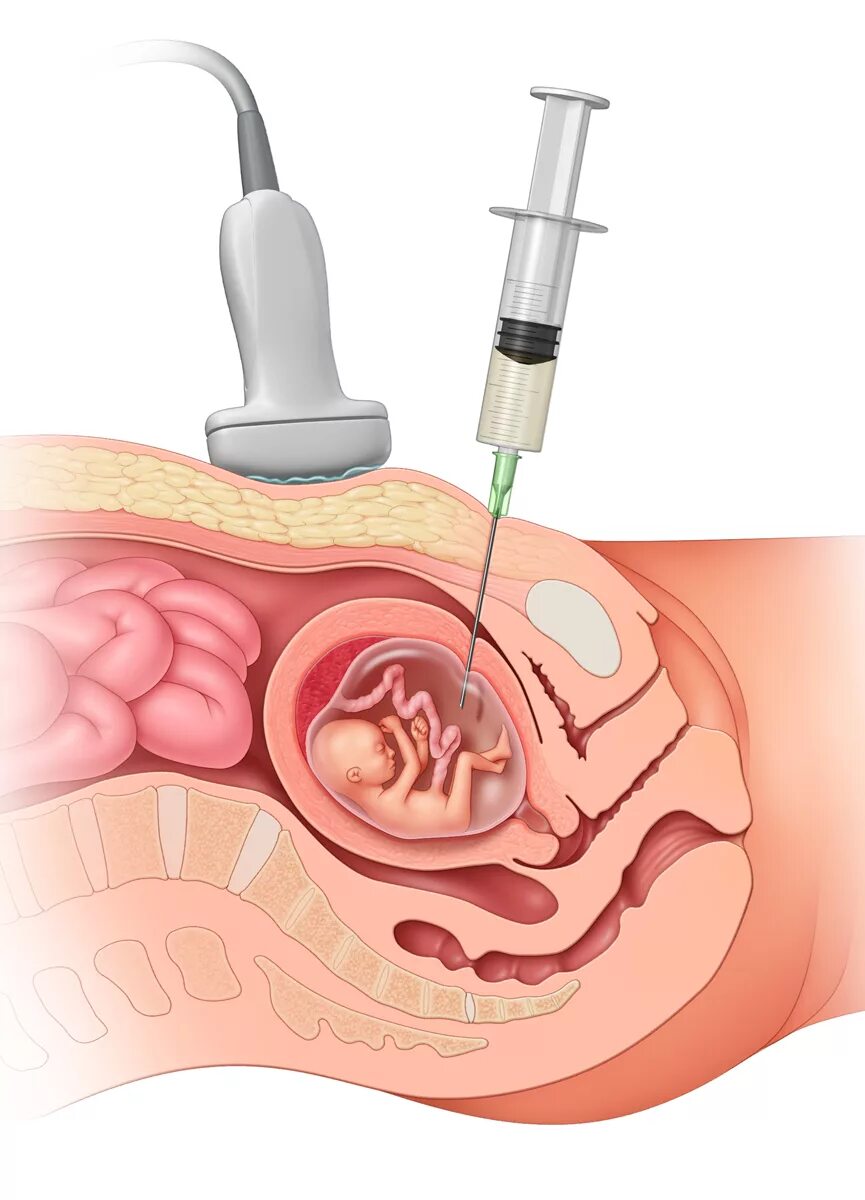 Плод в полости матки. Кордоцентез хорионбиопсия. Трансабдоминальный амниоцентез. Биопсия ворсин амниоцентез. Трансцервикальный амниоцентез.