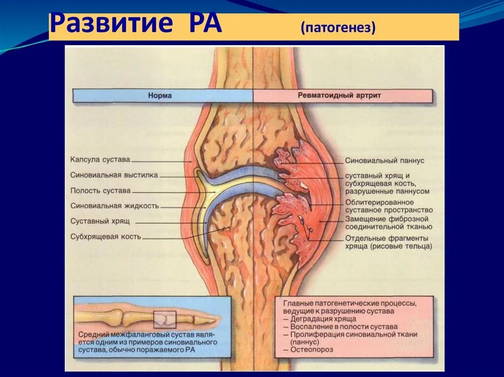 деформирующий артроз коленного сустава схема. остеоартрит и ревматоидный артрит. развитие артрита. ревматоидный артрит тофусы. деформирующий артроз коленного сустава классификация.