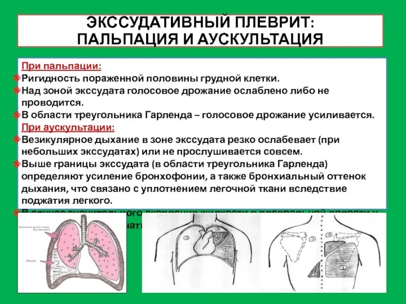 Боль в легких при кашле с мокротой. Экссудативный плеврит аускультация и перкуссия. Экссудативный плеврит звук при перкуссии. Пальпаторно экссудативный плеврит. Плеврит пальпация перкуссия аускультация.