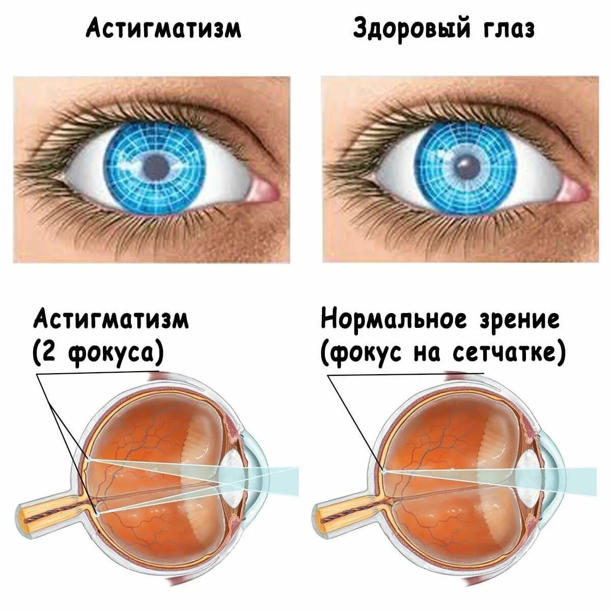 Замена хрусталика через сколько восстанавливается зрение