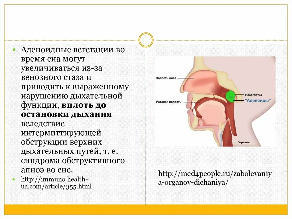 Аденоиды вегетации 2 степени. Аденоиды первой степени у ребенка 4 года. Вегетативные аденоиды. Вегетация у детей