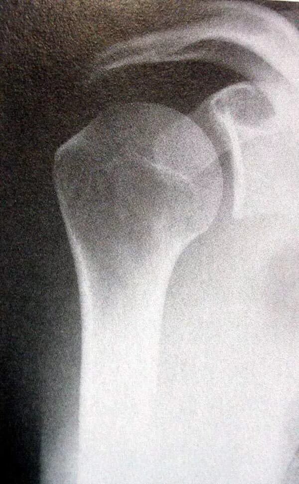 Вколоченный перелом шейки плеча. Аддукционный перелом хирургической шейки плеча рентген. Вколоченный аддукционный перелом хирургической шейки. Аддукционный перелом хирургической шейки плечевой кости рентген. Абдукционный перелом хирургической шейки плеча рентген.