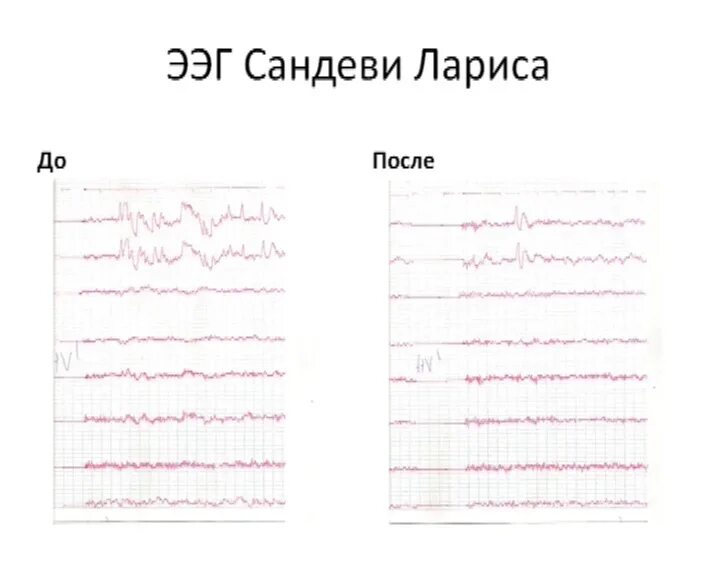 Электроды ЭЭГ. ЭЭГ картинки. ЭЭГ быстрого сна. Одноразовые электроды для ЭЭГ. Запись на ээг