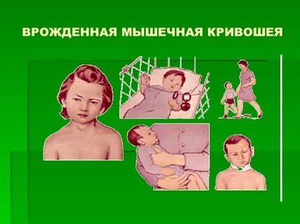 Мышечной кривошее