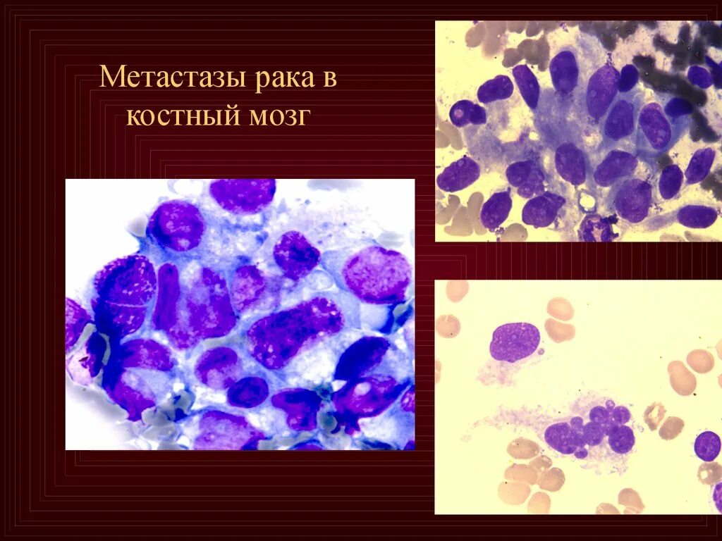 Миелограмма костного мозга. Миелограмма костного мозга хронический лимфолейкоз. Метастазы опухолей в костных мозг + цитология. Цитология метастазы в костном мозге. Опухоль клеток крови