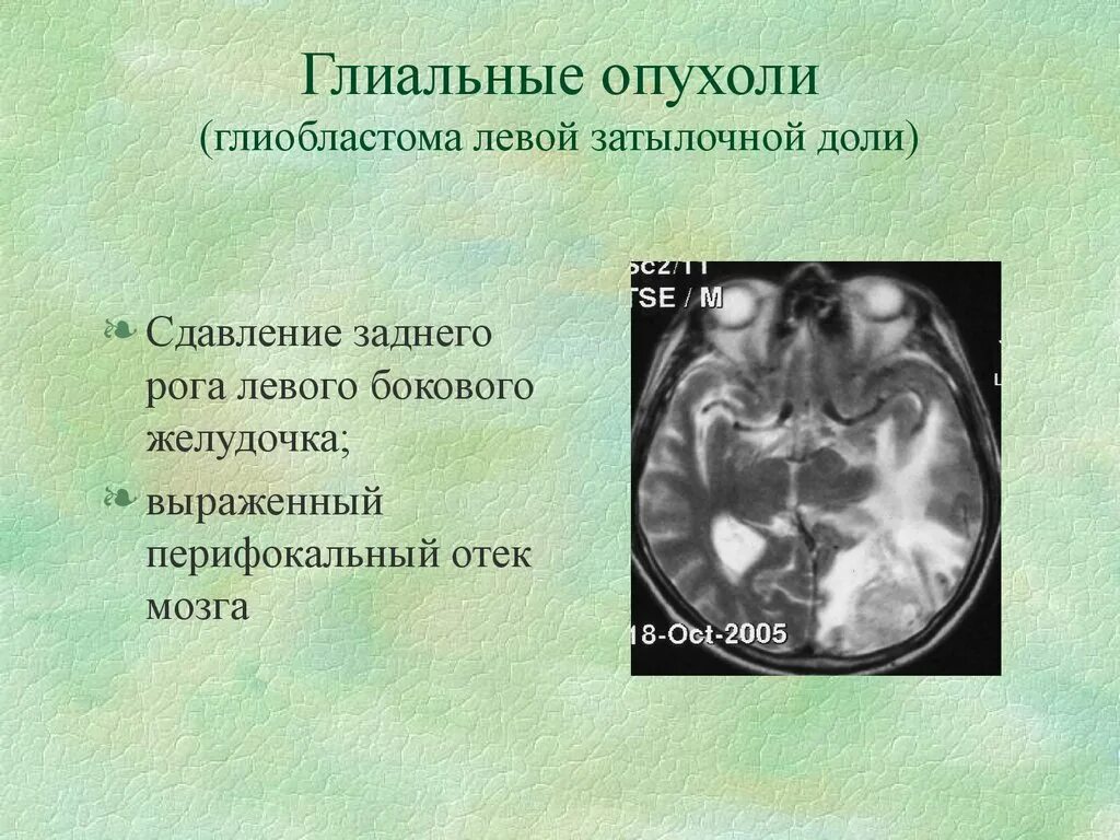 Глиальные опухоли мозга. Глиобластома затылочной доли. Глиальные опухоли головного мозга классификация. Глиальная опухоль головного