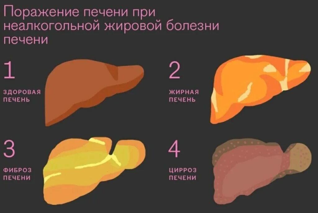 Как вылечить ожирение печени. Стадии жирового гепатоза. неалкогольная жировая болезнь печени стадии. жировой гепатоз стадии. жировой гепатоз печени 1 степени.