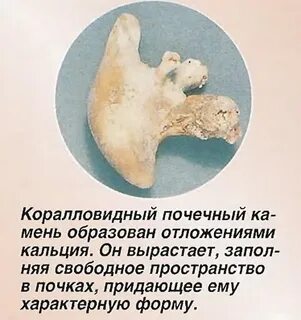 Коралловидный камень