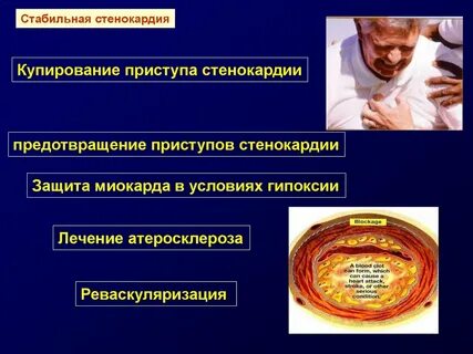 Стабильная стенокардия