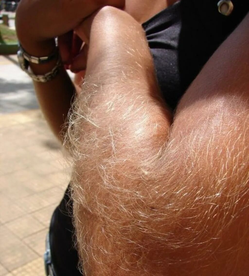 Extremely hairy