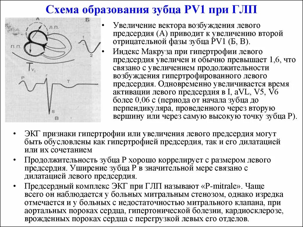 ЭКГ при гипертрофии отделов сердца. Индекс Макруза при гипертрофии левого предсердия. Признаки гипертрофии левого предсердия на ЭКГ. При гипертрофии левого предсердия. Левое предсердие увеличено