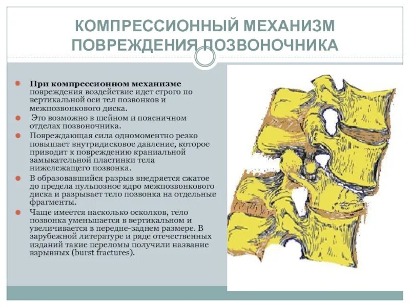 Сгибательно вращательный механизм повреждения позвоночника. Повреждения тел позвонков. Компрессионное повреждение позвоночника. Механизм компрессионного перелома позвонка.