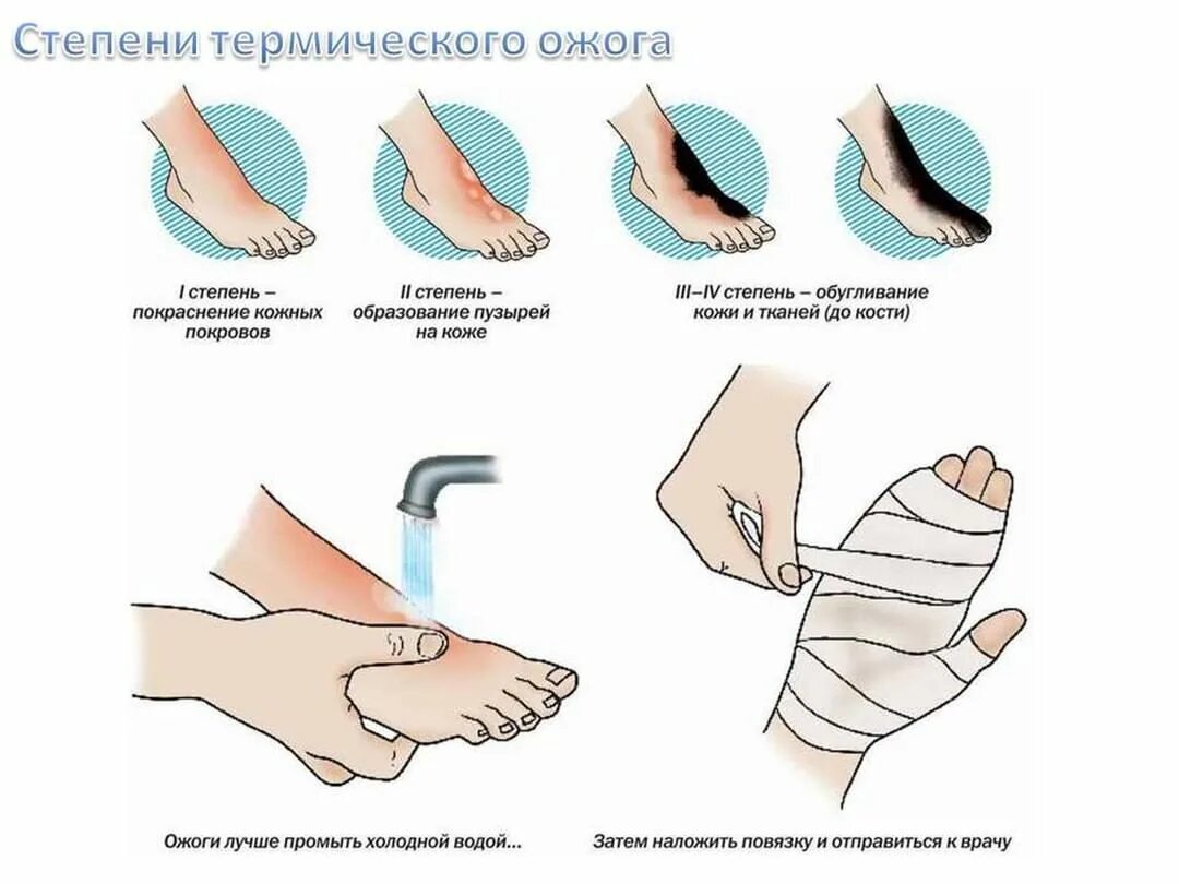 При ожоге необходимо оказать следующую первую помощь. Оказание первой медицинской помощи при ожогах. оказание первой помощи при термическом ожоге 1 степени. при термическом ожоге при оказании первой помощи необходимо. пмп при термических ожогах.